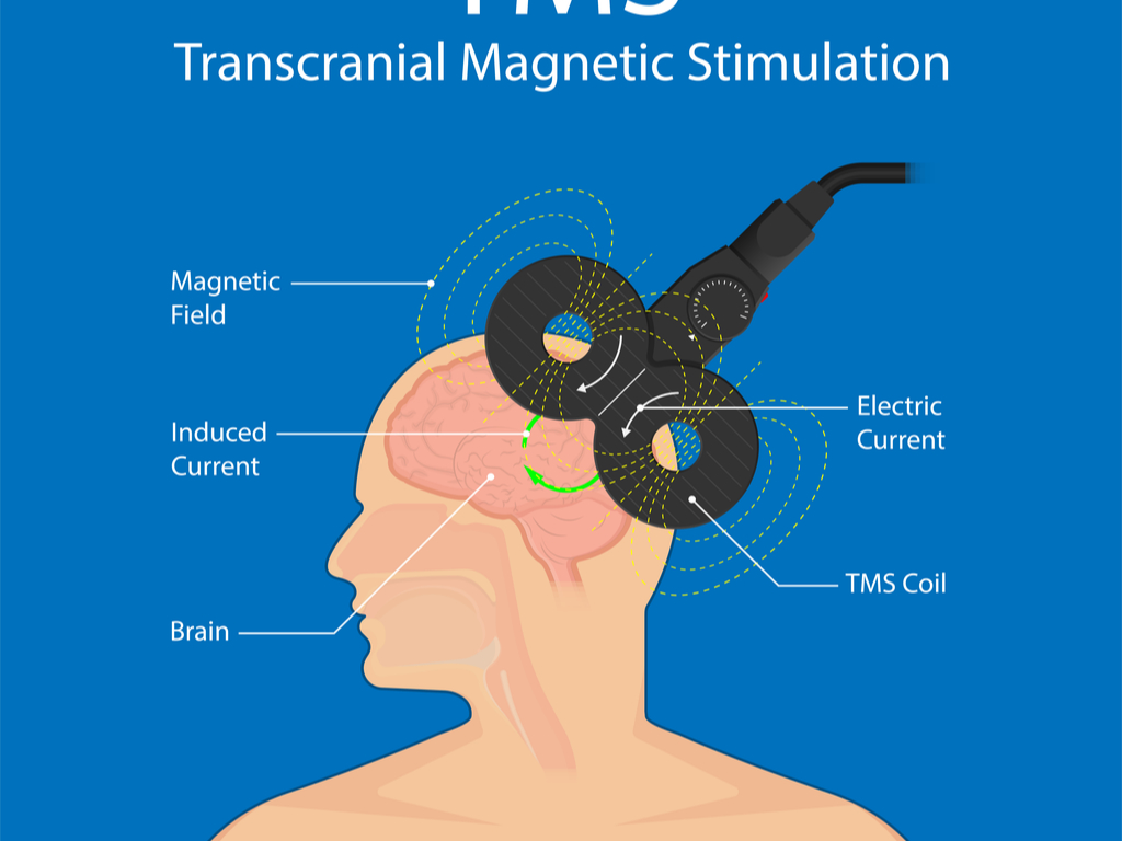 TMS therapy