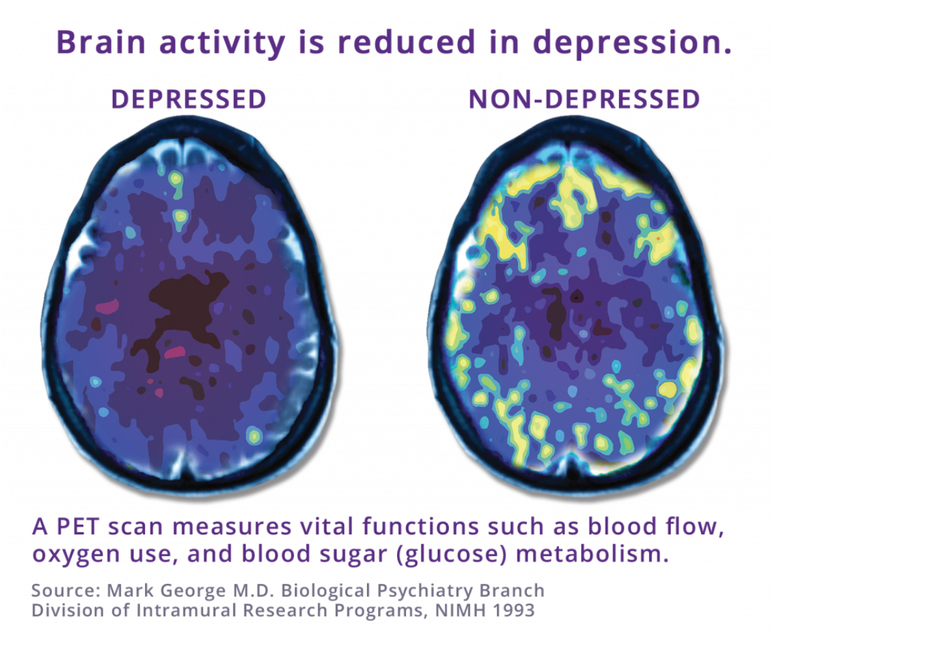 Depression Treatment NeuroStar TMS